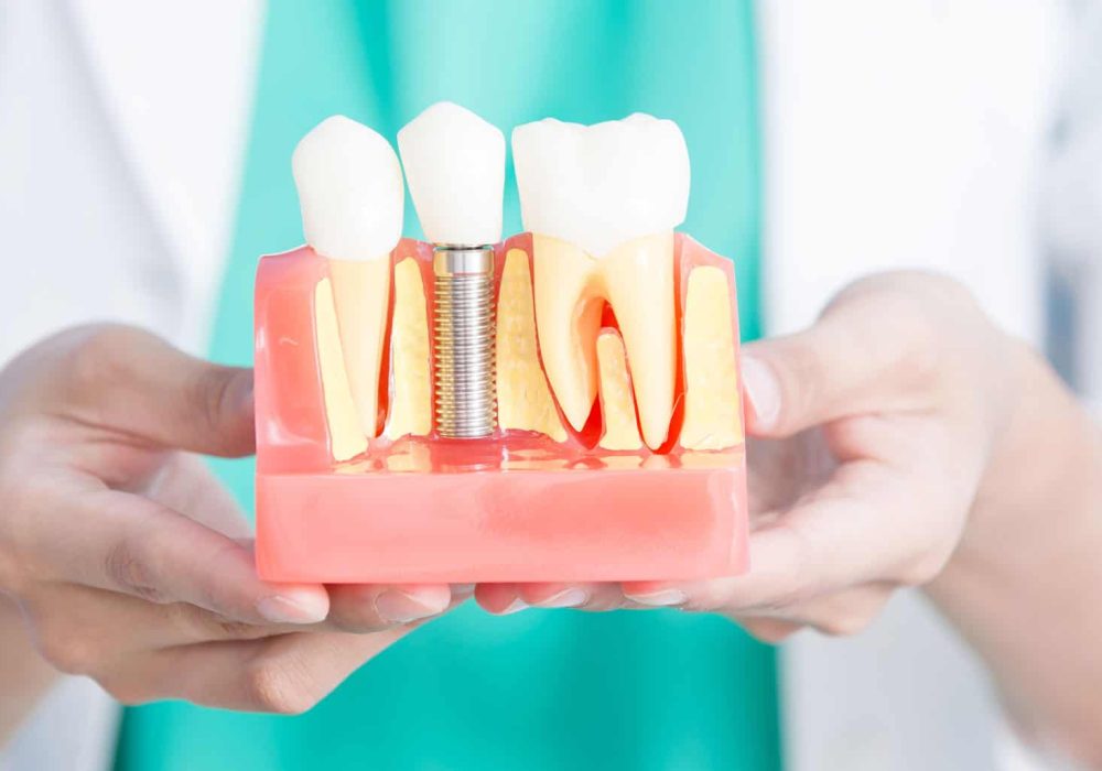 dental_implants-111